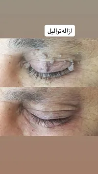 خدمة إزالة التواليل الجلدية