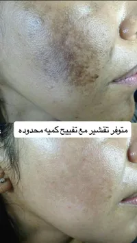 جلسة تقشير وتفتيح البشرة