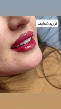 خدمة توريد الشفايف التجميلية