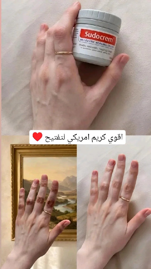 سودوكريم (Sudocrem) الأصلي لعلاج التسلخات والعناية بالبشرة. - إكسسوارات ومكياج وعناية - سوق غزة
